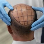 Fue Hair Transplant İstanbul